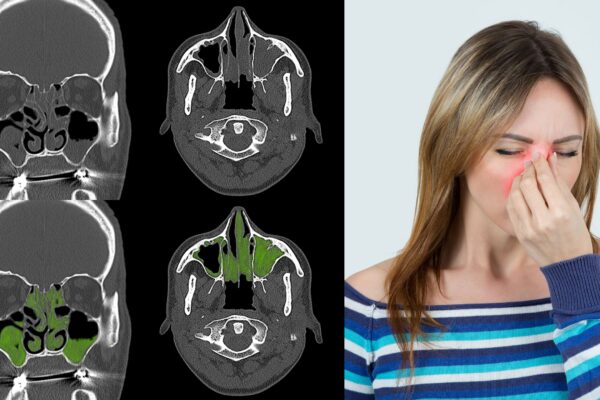 Sinusitis