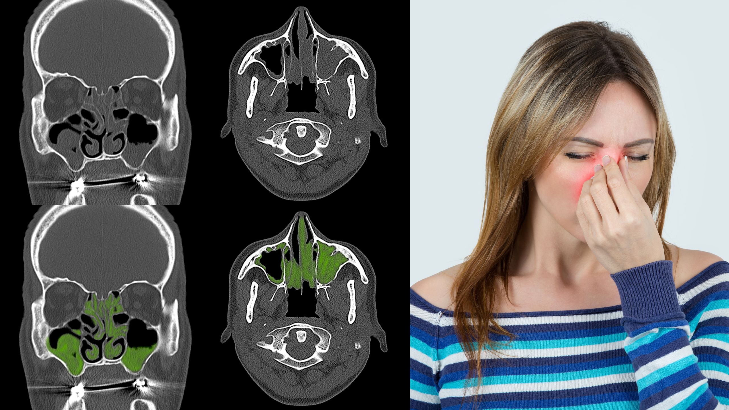 Sinusitis